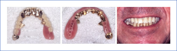Kombinationsarbeiten als abnehmbarer Zahnersatz auf eigenen Zähnen und Implantaten mit Riegeln.
