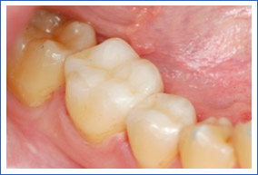 Inlays aus Kunststoff